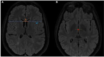 Predictive value of brain atrophy, serum biomarkers and information processing speed for early disease progression in multiple sclerosis